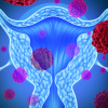 The Importance of Early Detection in Ovarian Cancer "From a Survivor's Perspective"