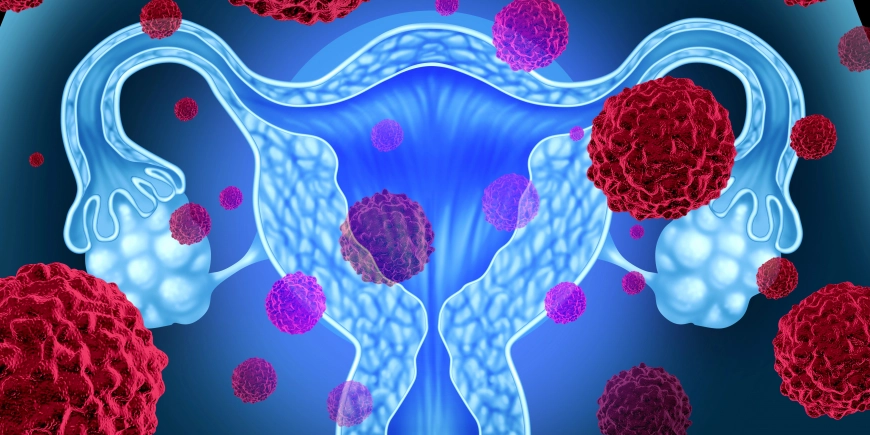 The Importance of Early Detection in Ovarian Cancer "From a Survivor's Perspective"
