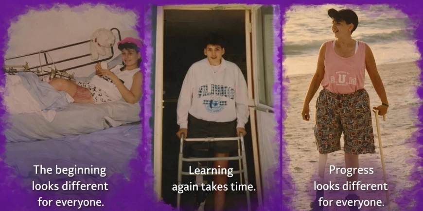 The Amputee Process Begins Before Surgery